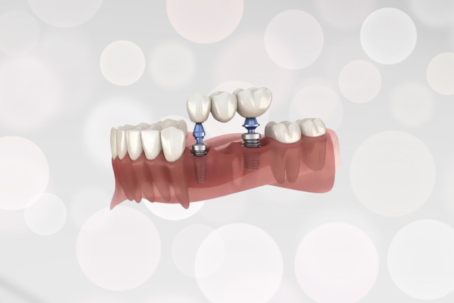 Zahnbruecken-Praxis-Videntist-Zahnarzt-1100-Wien