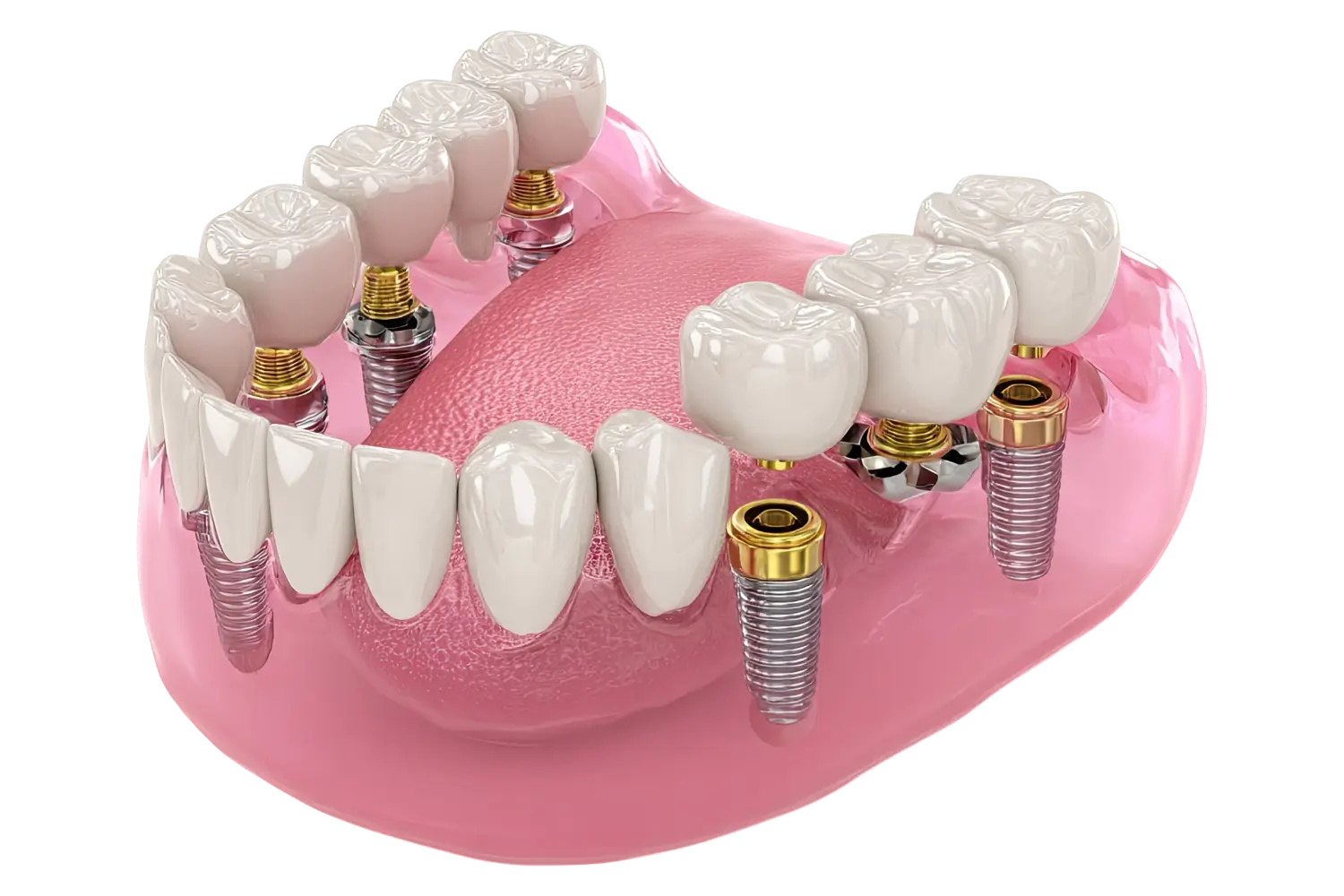 Zahnimplantate bei Dr. Nina Viden - Praxis Videntist in 1100 Wien